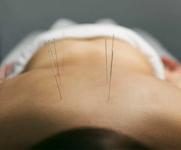 dry needling port st lucie