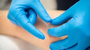 Treasure Coast dry needling
