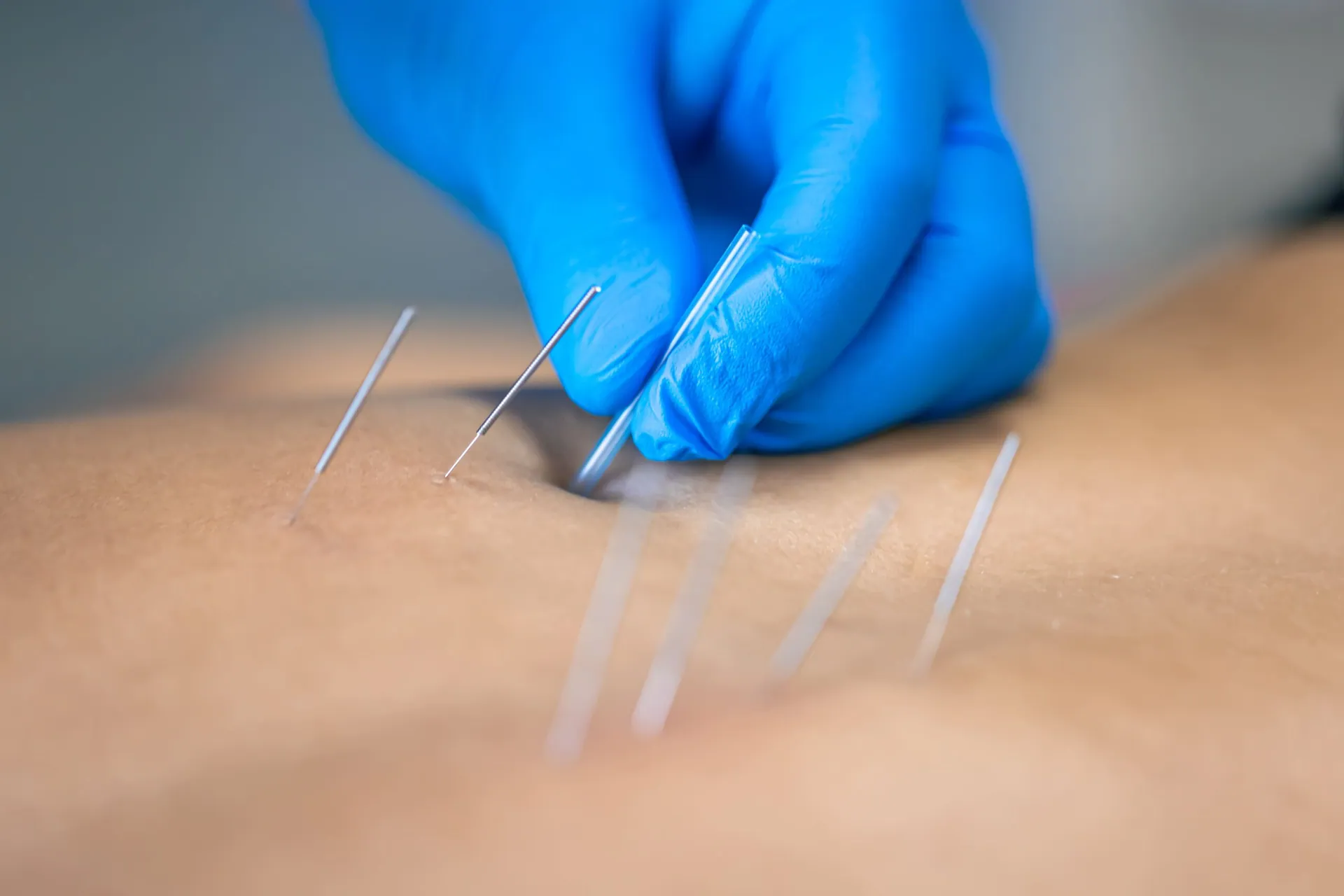 PSL-dry-needling-services