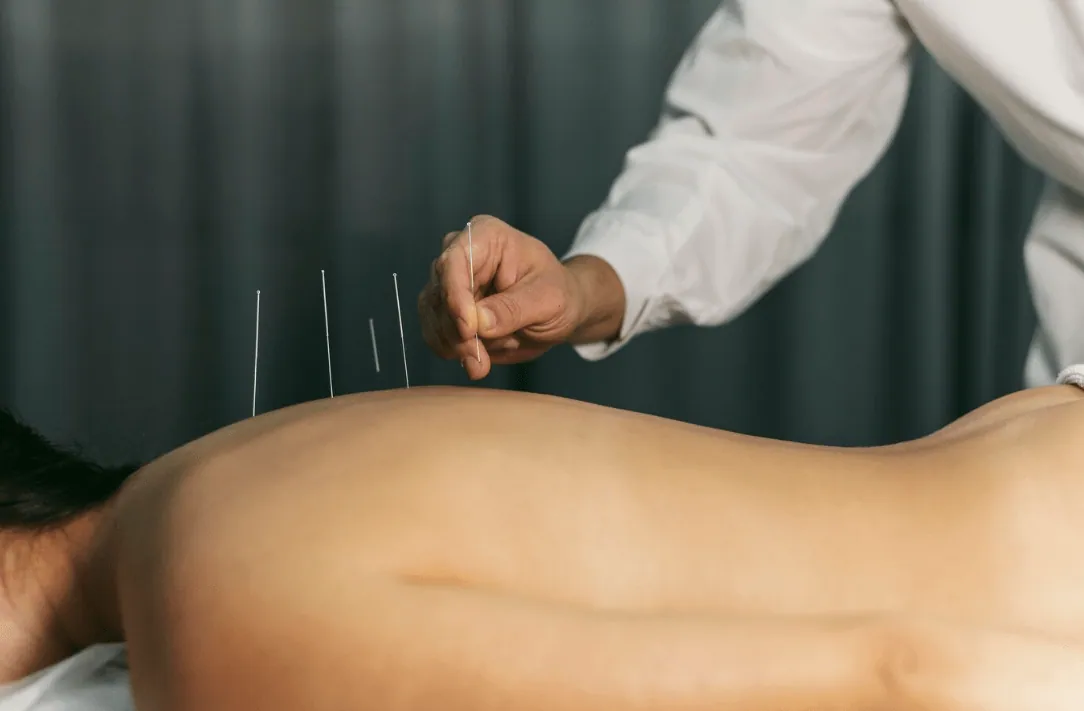 Licensed acupuncture in Port St Lucie