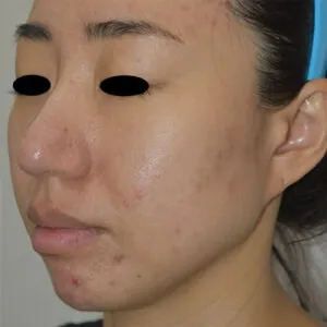 FL-microneedling-fort-pierce.jpg