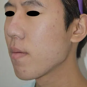 FL-microneedling-jensen-beacg.jpg