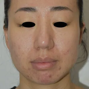 FL-microneedling-port-st-lucie.jpg