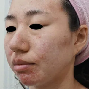 FL-microneedling-stuart.jpg