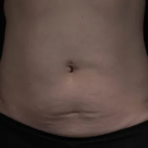Florida-rf-microneedling-jensen-beach-.jpg