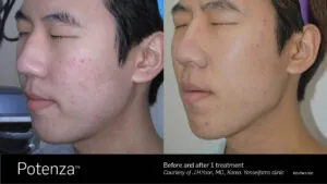 fort-pierce-microneedling-.jpg