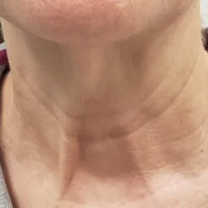 -port-st-lucie-rf-microneedling-.jpg