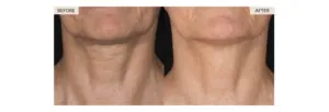 rf-microneedling-fort pierce-FL.jpg