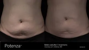rf-microneedling-fort-pierce-Florida.jpg
