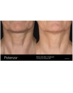 rf-microneedling-jenseb-beach-Florida.jpg