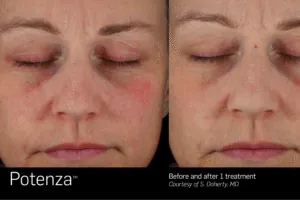 rf-microneedling-jensen-beach-fl