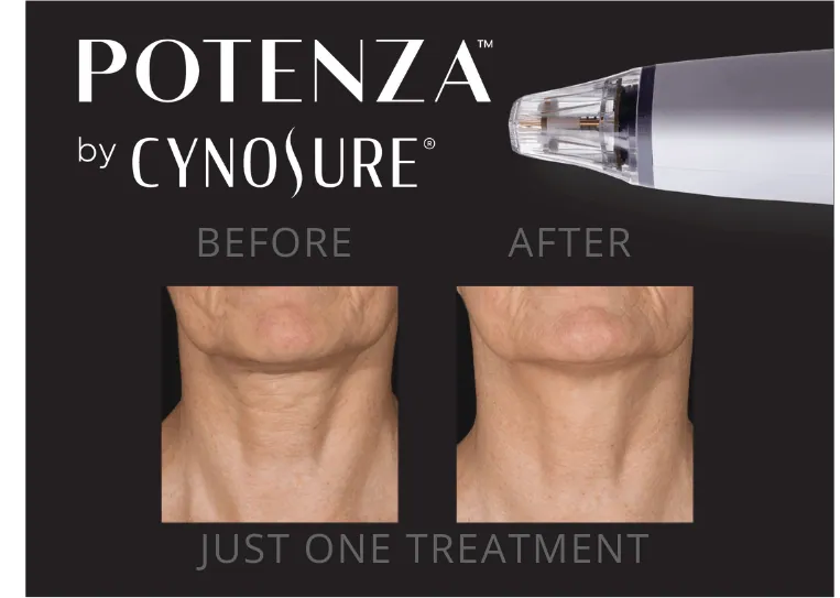 Rf microneedling jensen beach.