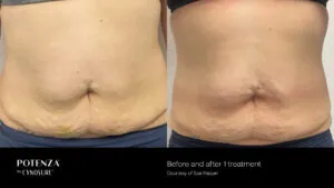 rf-microneedling-port-st-lucie-fl.jpg