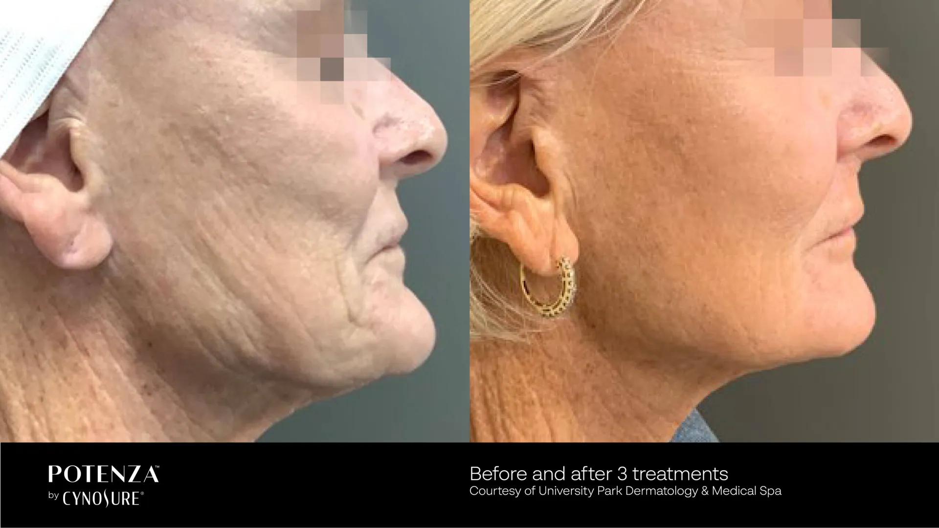 Rf microneedling port st lucie.