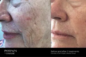 rf-microneedling-stuart-fl