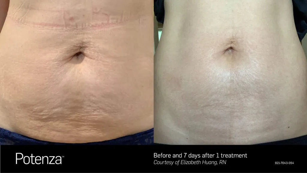 Rf microneedling stuart.