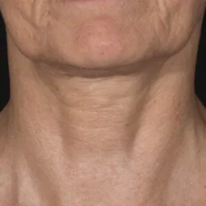 rf-microneedling-treasure coast-FL.jpg