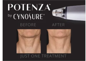 rf-microneedling-treasure-coast-Florida.jpg