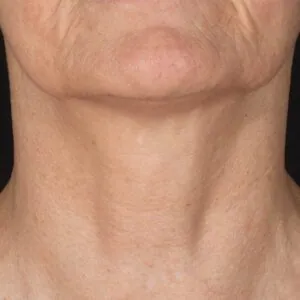 rf-microneedling-treasure coast.jpg