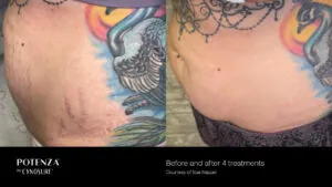 stuart-rf-microneedling-.jpg