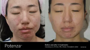 stuart-rf-microneedling-FL-.jpg