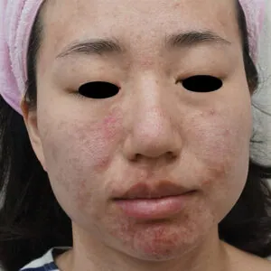 treasure-coast-FL-microneedling-.jpg