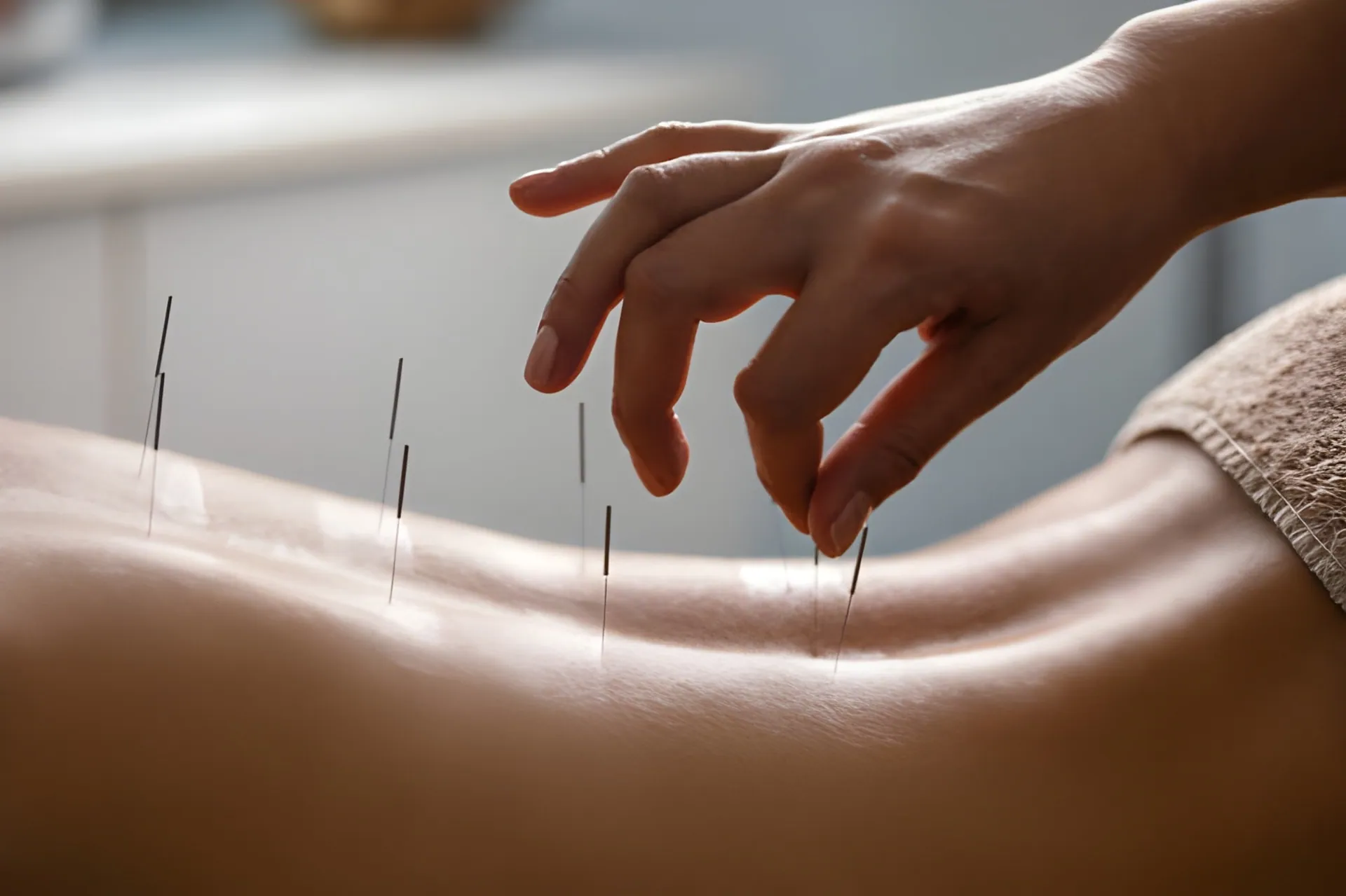 Acupuncture Port St Lucie patient receiving back acupuncture with needles placed along the spine in a calm clinical setting.