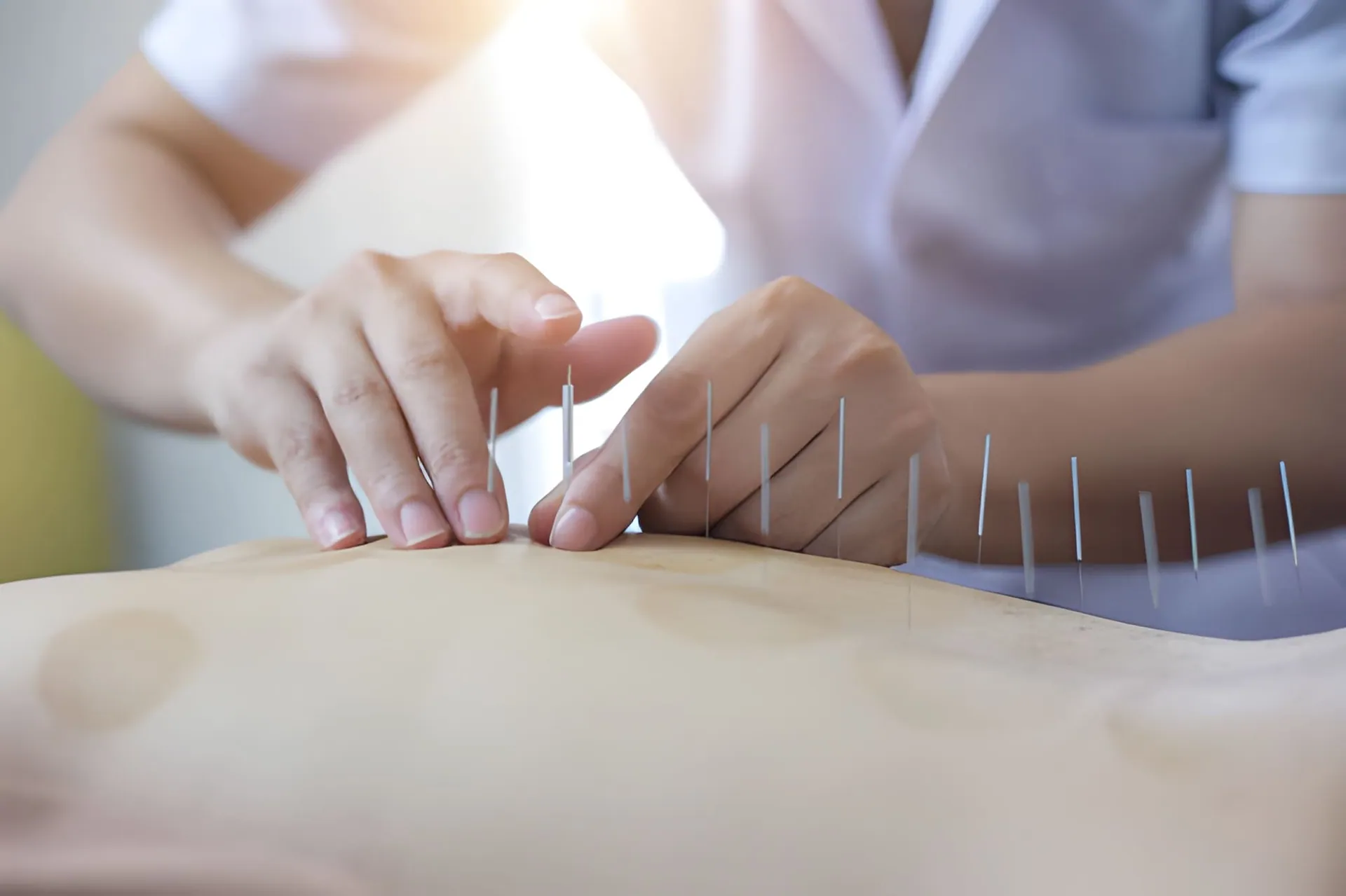 Acupuncture Port St Lucie FL practitioner placing needles along patient’s back in clinical wellness setting.