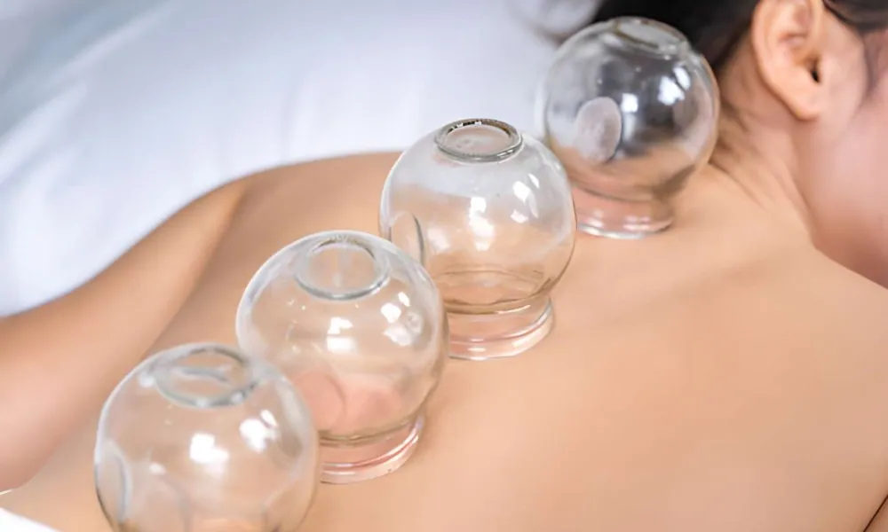 Acupuncture Port St Lucie FL cupping therapy session with glass cups applied along spine for muscle relief and circulation.
