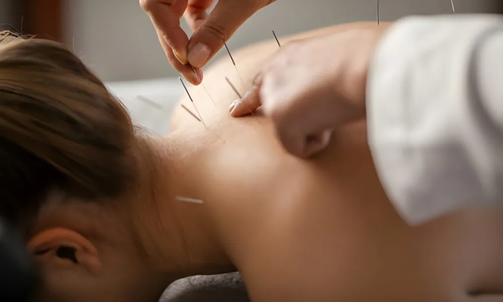Acupuncture Port St Lucie patient lying face down while a practitioner inserts needles along the upper back and neck.